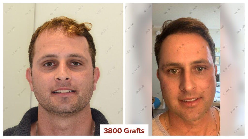 hair transplant before and after