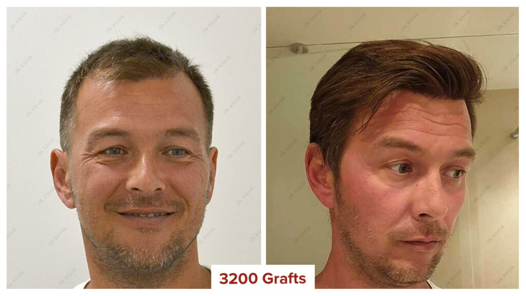 Hair Transplantation before and after