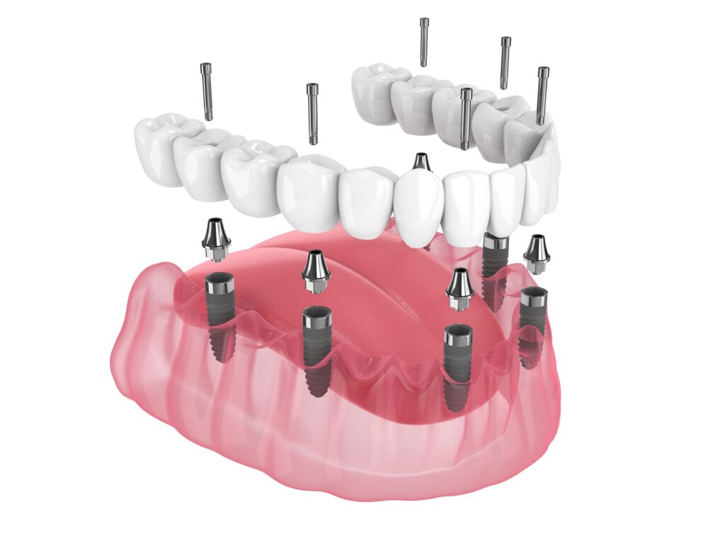 all-on-6-dental-implant