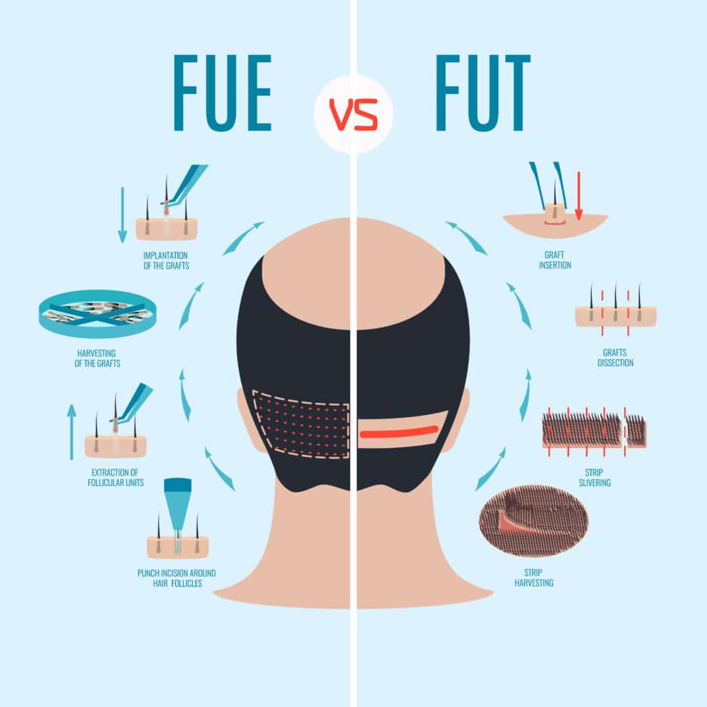 fue vs. fut hair transplantation