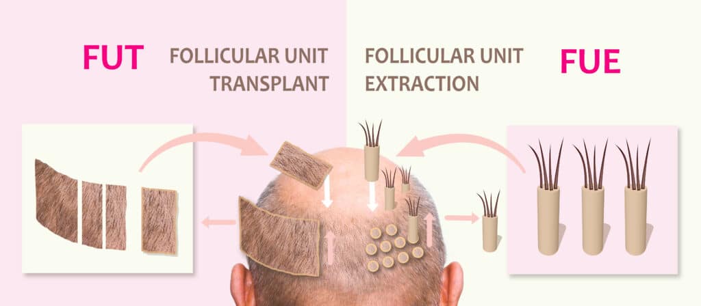 fue hair transplant vs fut hair transplant