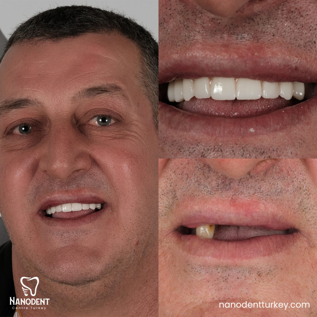 nanodent Mabrouk dental implant allon6 dental treatment before after dental review