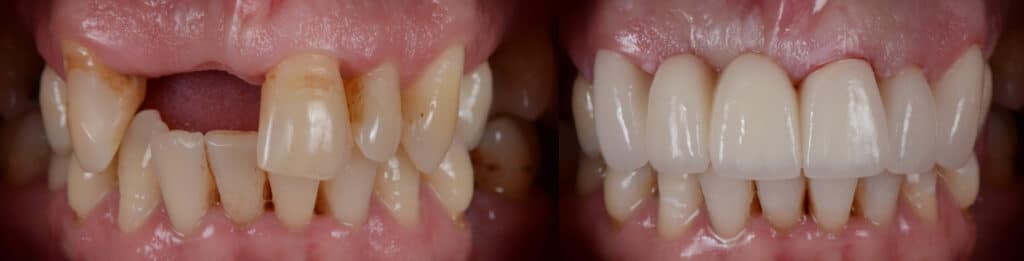 dental bridge before and after