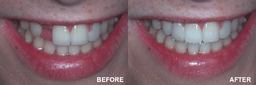 dental bridge before after 5