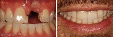 dental bridge before after2